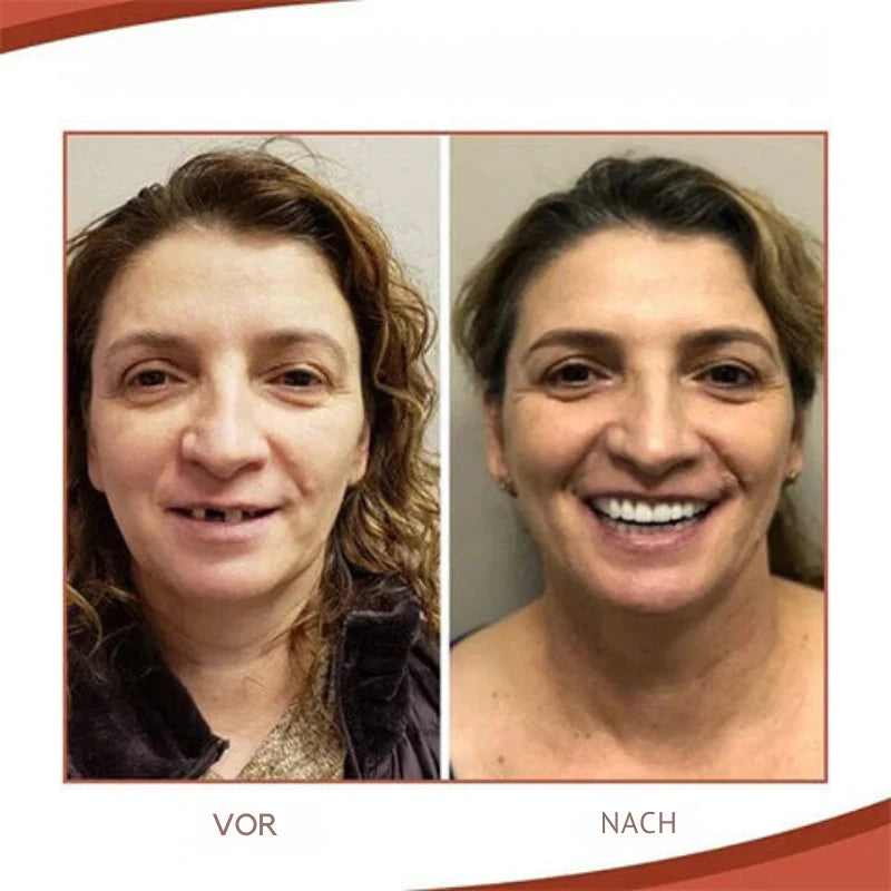 Biocompatible Silicone Denture Kit for a Comfortable Fit and a Natural Smile
