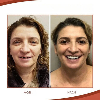 Dentures | Tailored Fit Dental Prosthetics | Stable Grip & Authentic Smile