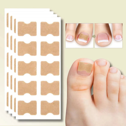Ingrown Toenail Patches Elastic Peel-and-Stick Set of 20