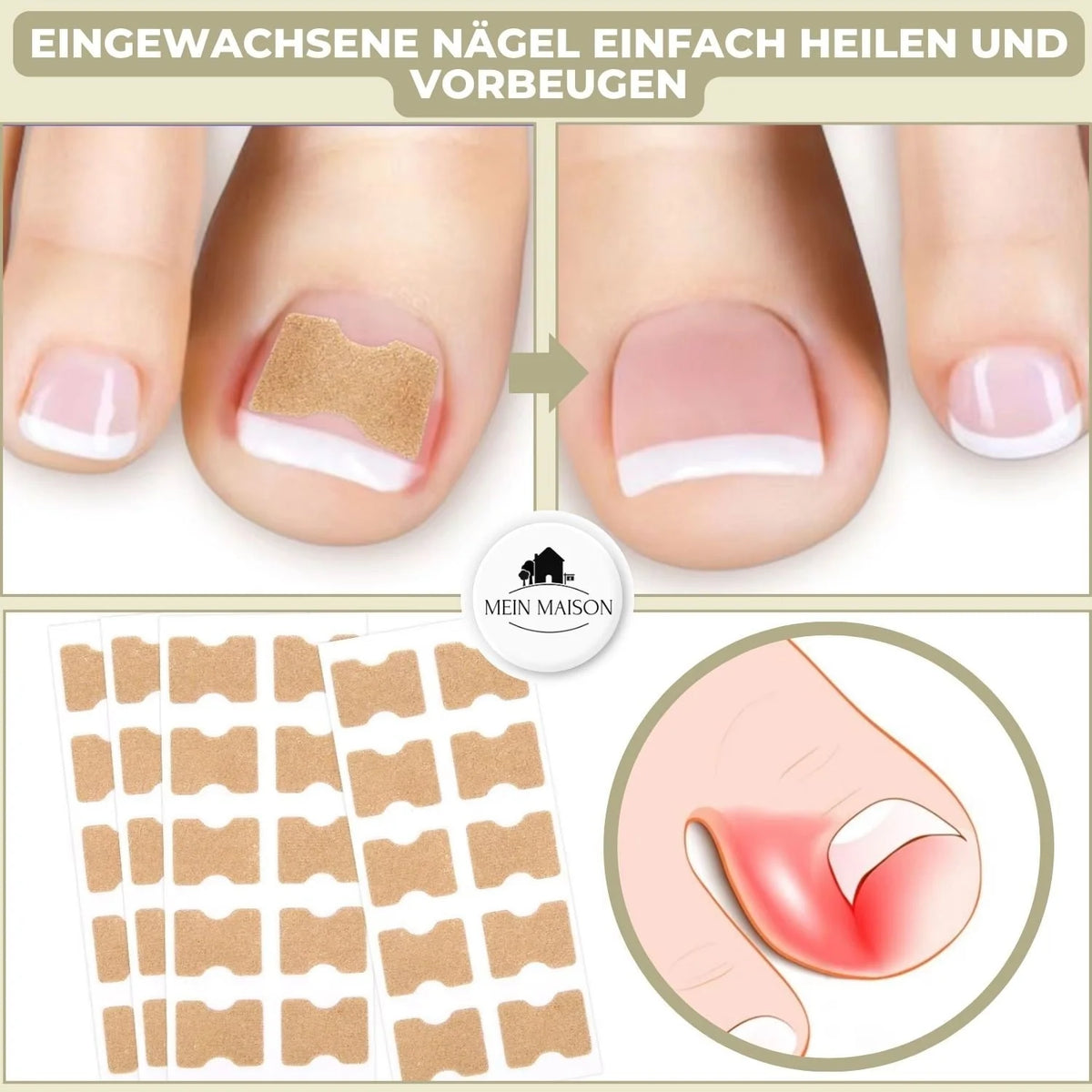 Ingrown Toenail Patches Elastic Peel-and-Stick Set of 20