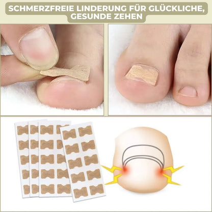 Ingrown Toenail Patches Elastic Peel-and-Stick Set of 20