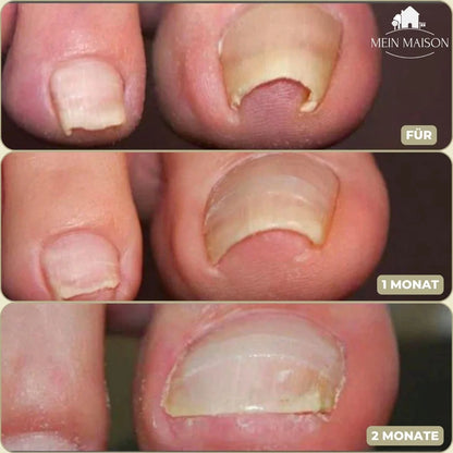 Ingrown Toenail Patches Elastic Peel-and-Stick Set of 20