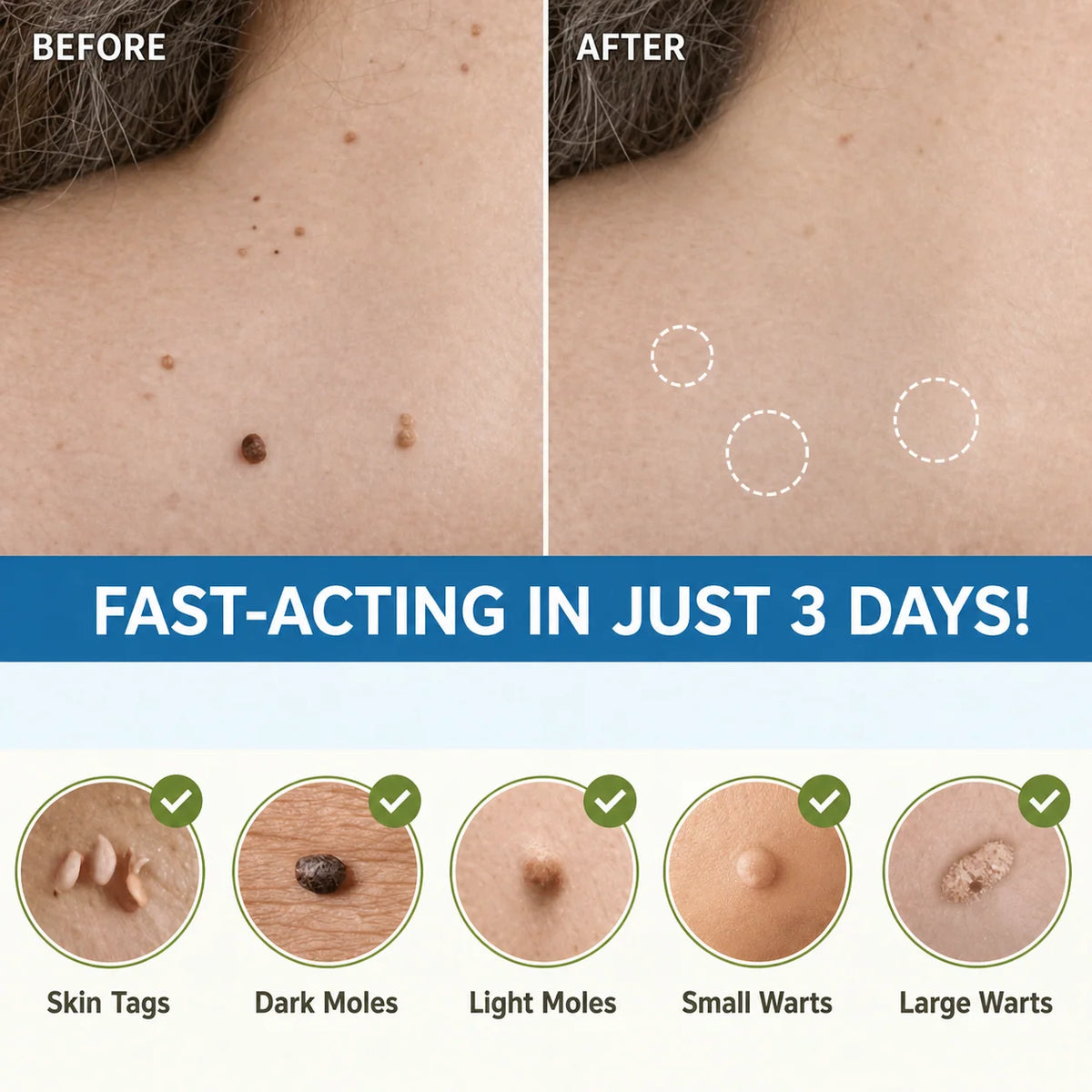 Skin Tag Remover Patches Gentle Non-Invasive Application