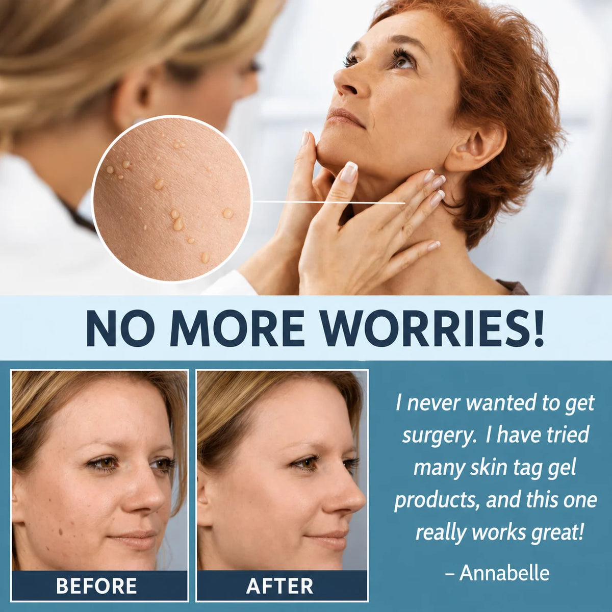 Skin Tag Remover Patches Gentle Non-Invasive Application