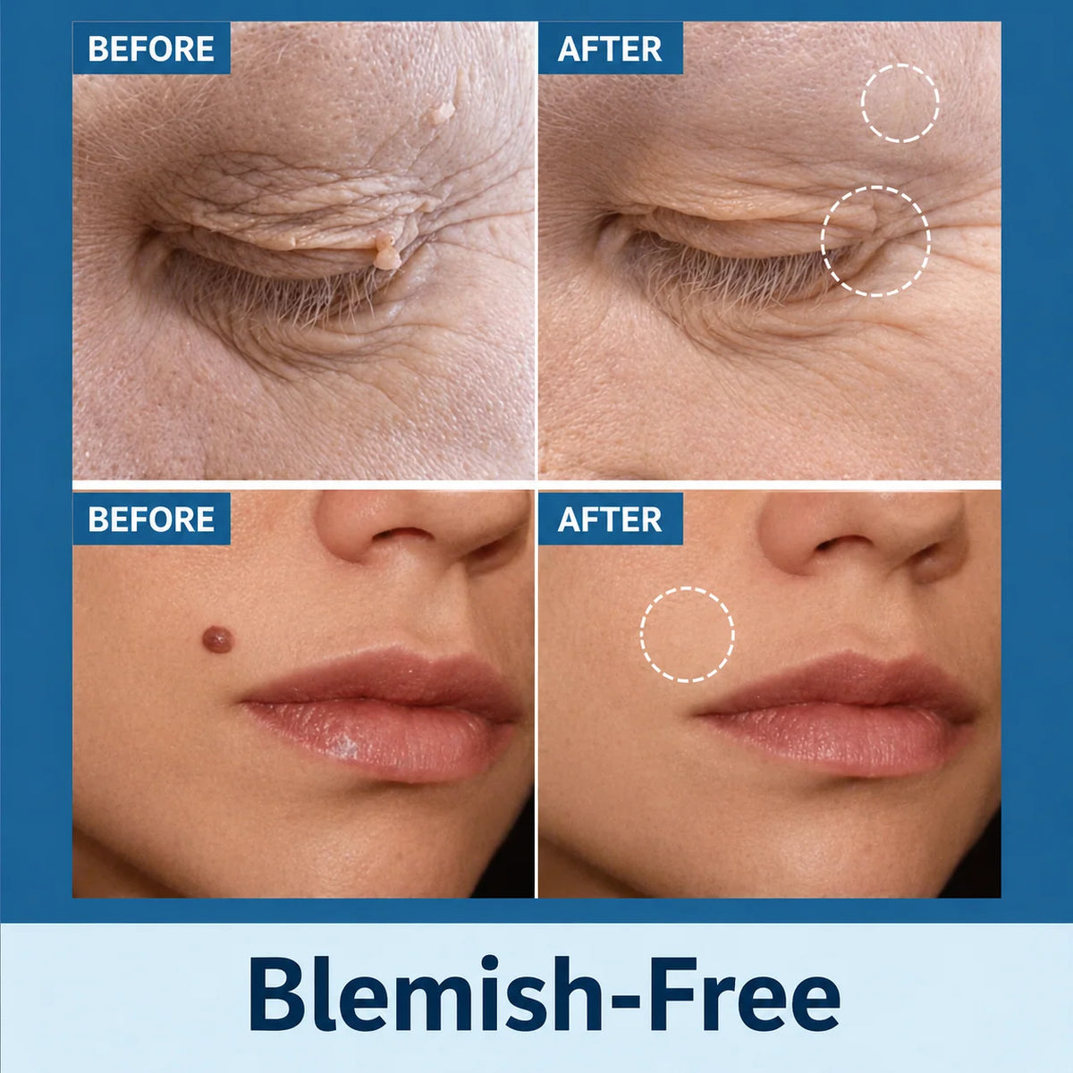 Skin Tag Remover Patches Gentle Non-Invasive Application