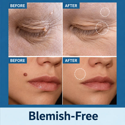 Skin Tag Remover Patches Gentle Non-Invasive Application